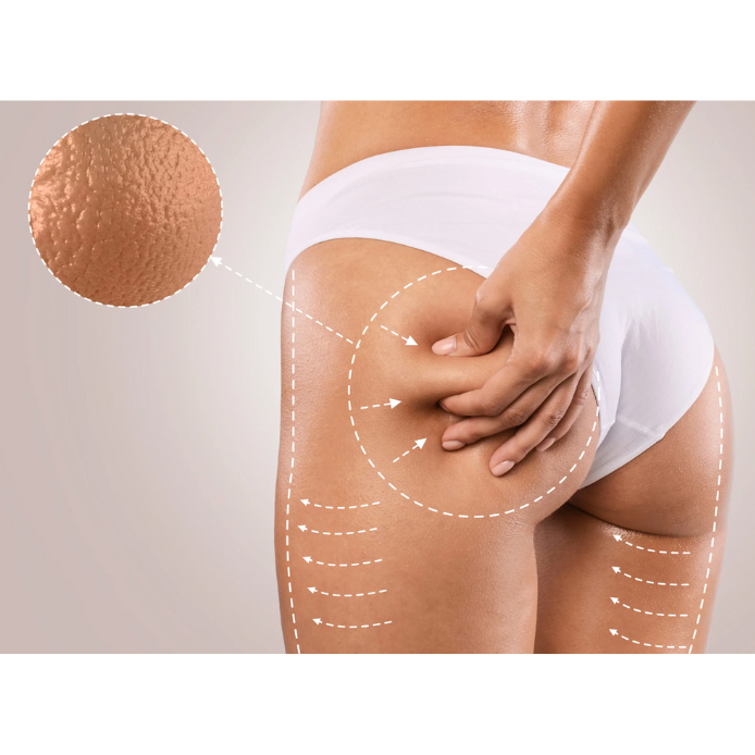 NovaSlim RF+EMS – inteligentny masażer wyszczuplający